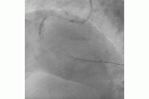 Two Simultaneous Complications in a Tortuous, Calcified Right Coronary Artery 