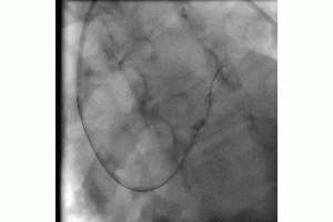 Inflated Balloon Trapped in Left Main Coronary
