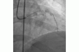 A Case of Imaging Guided Left Main PCI 