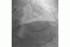 Huge LM Thrombosis during Antegrade PCI for LCX-CTO