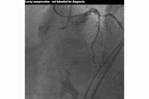 A Calcified and Tortuous RCA CTO 