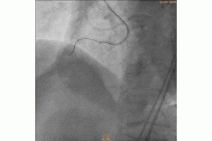 Calcified and “Leaky” Vessel 