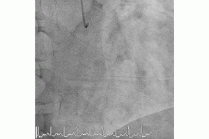 Safely Save an Ellis Type 3 Perforation with One Guiding Catheter 