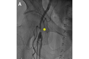 Recurrent Common Femoral Artery Stenosis after Surgical Knot Closure: Cut the Knot using Directional Atherectomy