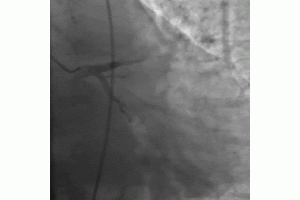 Large Thrombus in an Ectatic Big Right Coronary Artery