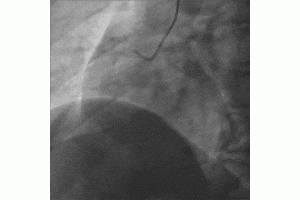 An Iatrogenic Dissection of Right Coronary Artery