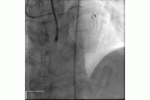 Dual Lumen Catheter assisted Retrograde CTO Intervention