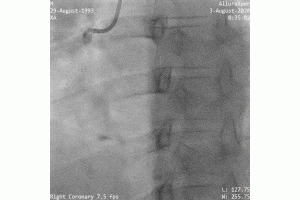 The Youngest STEMI I Have Seen!