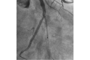 “Double Kissing String Culotte Technique” for Bifurcation PCI: Could we Make it Real with Modern Generation of Stent?