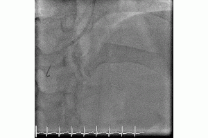 The Beauty of Retrograde CTO Wiring Technique to Rescue Complex and Complicated